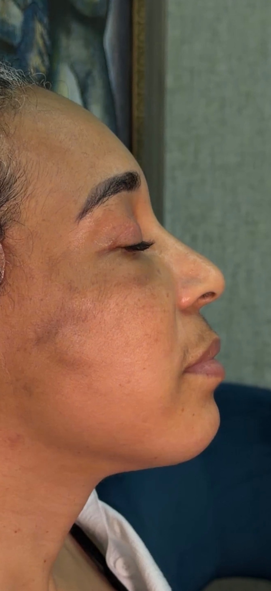 Blefaroplastia 3